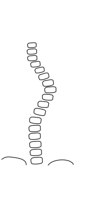 脊柱側(cè)彎的發(fā)展與生長