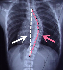 脊柱側(cè)彎后身高會變短嗎？