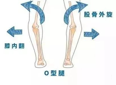 孩子“O”型腿怎么辦？