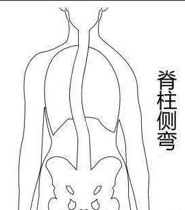 脊柱側(cè)彎康復(fù)訓(xùn)練主要從四個方面入手！