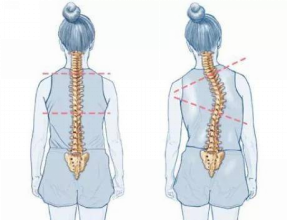 怕耽誤學(xué)習(xí)，脊柱側(cè)彎就不治療了嗎？